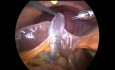 Laparoskopowa cholecystektomia z przewodem pęcherzykowym dodatkowym