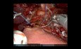 Robotyczna pankreatoduodenektomia z antrektomią w przypadku miejscowo zaawansowanego gruczolakoraka dwunastnicy