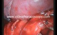 Wideotorakoskopowa lobektomia płata górnego płuca lewego przeprowadzona przez jeden port.