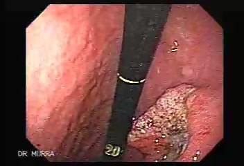 Rak żołądka - wczesne stadium