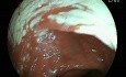 Colonoscopy Image Interpretation - Case