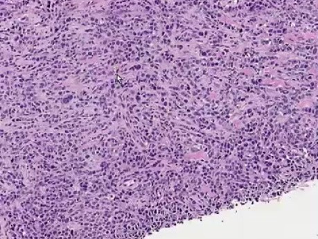 Chłoniak rozlany z dużych komórek B - histopatologia - masa w okolicy przedkrzyżowej