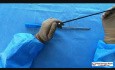 Haczyk laparoskopowy