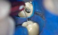 1-minutowe kliniczne wskazówki dotyczące niedrożności kanału korzeniowego