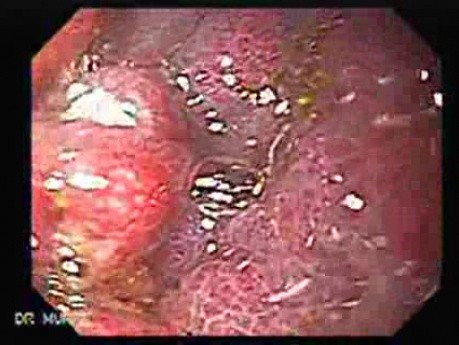 Rak żołądka - endoskopia (3 z 15)