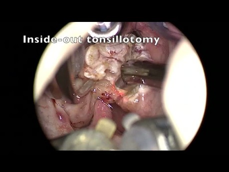 Częściowa tonsillektomia