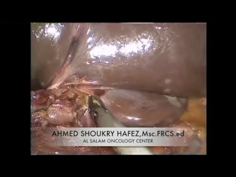 Pankreatoduodenektomia (operacja Whipple'a) metodą laparoskopową
