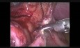 Laparoskopowe leczenie perforacji przełyku po endoskopii