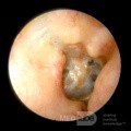 Złamanie kości skroniowej (ucho prawe)