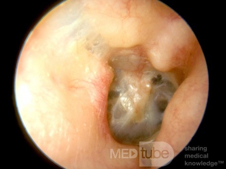 Złamanie kości skroniowej (ucho prawe)