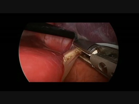 Splenektomia laparoskopowa u dziecka