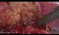 Zapalenie i poszerzenie przewodu pęcherzykowego z powodu przewlekłego kamiczego zapalenia pęcherzyka żółciowego
