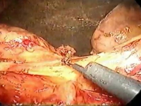 Pankreatoduodenektomia - metoda Whipple'a