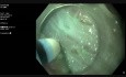 Endoskopowa dysekcja podśluzówkowa 30 mm ubytku w górnej odbytnicy