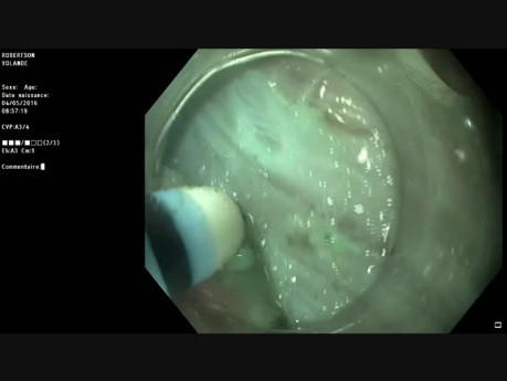 Endoskopowa dysekcja podśluzówkowa 30 mm ubytku w górnej odbytnicy