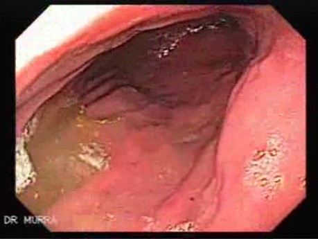 Rak gruczołowy jamy odźwiernikowej (2 z 3)
