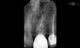 Mikrochirurgiczne leczenie endodontyczne niedrożnego wierzchołka kanału z perforacją