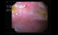 Krwawienia z górnego odcinka przewodu pokarmowego w badaniu endoskopowym, typ II wg Forresta