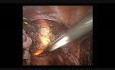 Histerektomia laparoskopowa z użyciem podświetlanego manipulatora