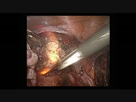 Histerektomia laparoskopowa z użyciem podświetlanego manipulatora