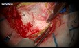 Hemostatyczne i uszczelniające działanie matrycy TachoSil w neurochirurgii