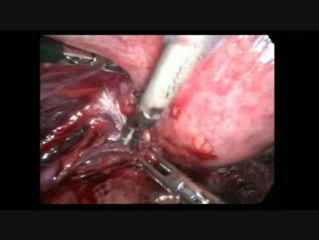 Operacja laparoskopowa endometriozy