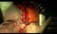 Pankreatoduodenektomia sposobem Traverso-Longmire