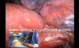 Wideotorakoskopowa lobektomia płata górnego płuca lewego z powodu raka, przeprowadzona przez jeden port.