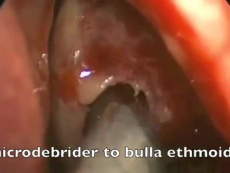 Funkcjonalna endoskopowa operacja zatok - śluzowiak komórki sitowej