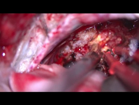 Schwannoma nerwu przedsionkowo-ślimakowego - operacja z dojścia retrosigmoidalnego
