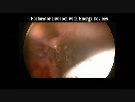 Podpowięziowe endoskopowe przecinanie perforatorów (SEPS) - połączenie odstrzałkowo-podkolanowe (SPJ)