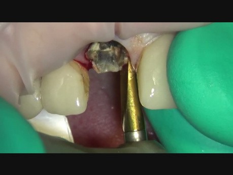 Mikrochirurgia implantologiczna: technika ekstrakcji zęba