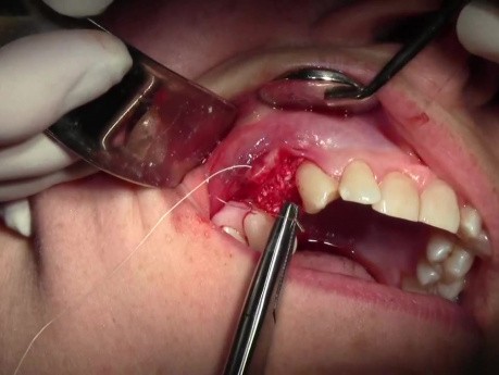 Augmentacja grzbietu wyrostka zęba 1-5 