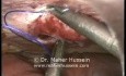 Laparoskopowa redukcja i naprawa przepukliny powstałej w ranie po użyciu trokara