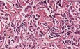 Rak przewodów żółciowych, umiarkowanie zróżnicowany - histopatologia - wątroba