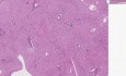 Sercowopochodna marskość wątroby - histopatologia wątroby