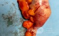 Usunięty laparoskopowo nowotwór wyrostka robaczkowego