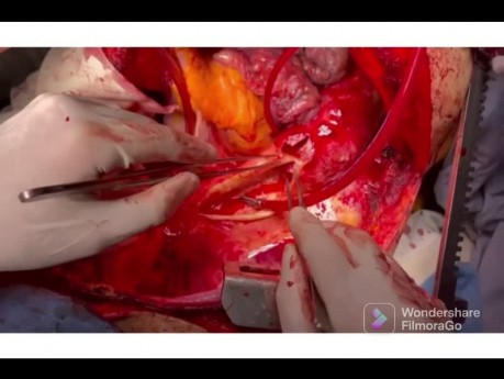Operacja tętniaka aorty piersiowo-brzusznej