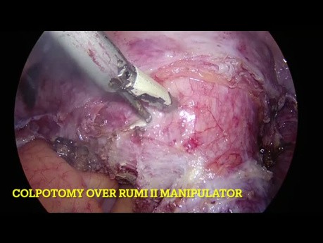 Całkowita histerektomia laparoskopowa – mięśniak macicy