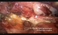 Resekcja endometrialnego guzka maciczno-krzyżowego