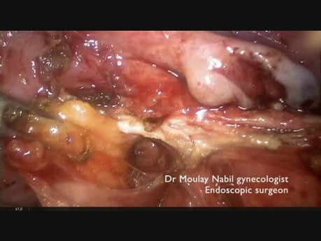 Resekcja endometrialnego guzka maciczno-krzyżowego