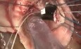 Wymiana zastawki aortalnej 2 - technika operacyjna