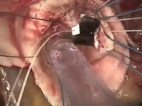 Wymiana zastawki aortalnej 2 - technika operacyjna