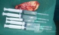 Pęcherzyk żółciowy usunięty metodą laparoskopową 