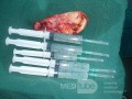 Pęcherzyk żółciowy usunięty metodą laparoskopową 
