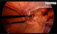 Laparoskopowa operacja przepukliny pachwinowej