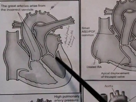 Krążenie płodowe i wrodzone wady serca: część 3