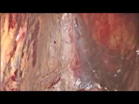 Resekcja krętniczo-kątnicza z wykorzystaniem metody laparoskopowej