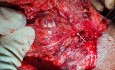 Deep Lobe Parotid Tumour (Exposure after Superficial Parotidectomy)