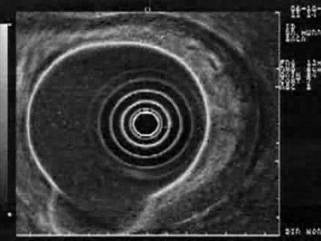 Rak włóknisty żołądka - ultrasonografia endoskopowa (9 z 15)